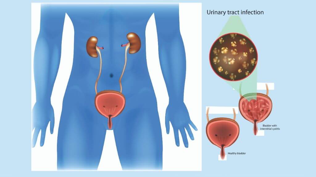 Urinary Tract Infection Causes Symptoms And Long Term Outlook 1md